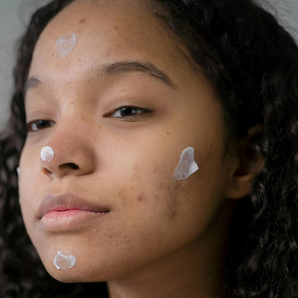 Femme appliquant la crème hydra-apaisante anti-imperfections bio sur les rougeurs de son visage