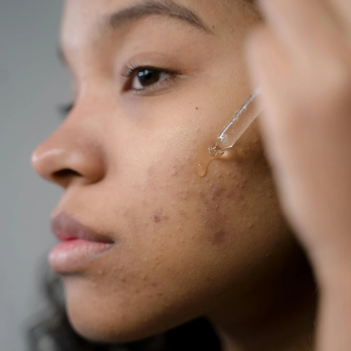 Femme avec quelques imperfections appliquant un sérum exfoliant anti-imperfections bio sur son visage